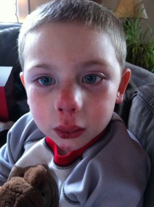 Broken Nose